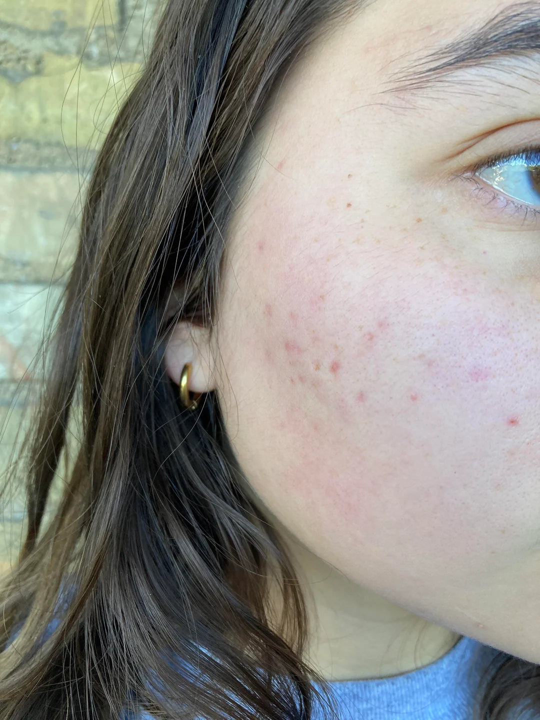 Post Inflammatory Erythema (PIE)