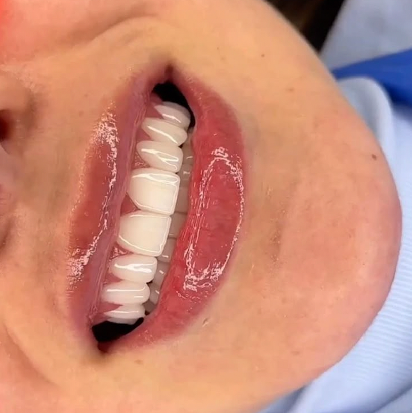 Teeth Whitening Course