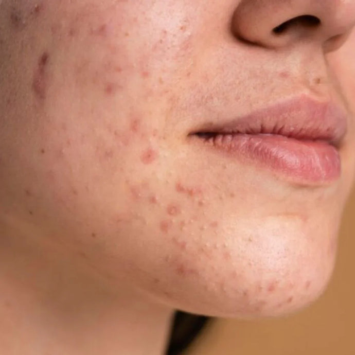 Is Skin Purging Normal? What You Should Know